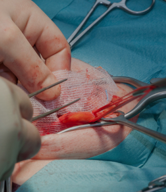 Open Hernia Surgery